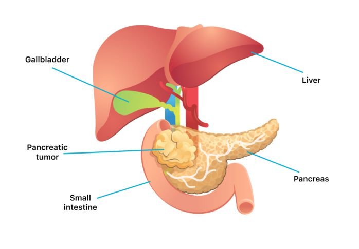 signs that pancreatic cancer has spread to liver