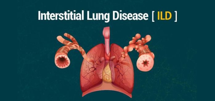 What causes of interstitial lung disease?